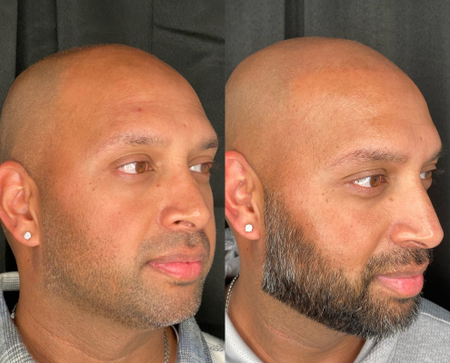 before and after scalp micropigmentation