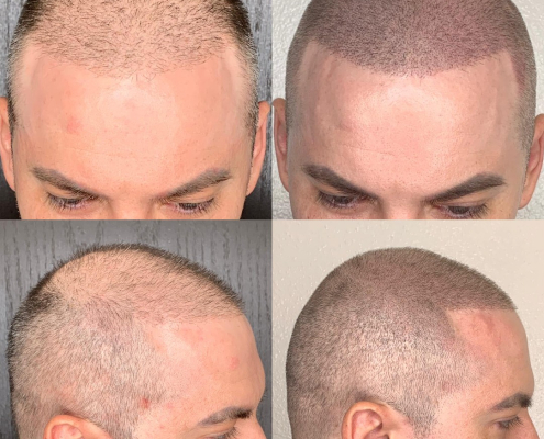 before and after scalp micropigmentation