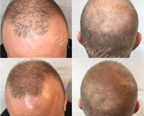 Blonde Scalp Micropigmentation hairloss tattoo near me density