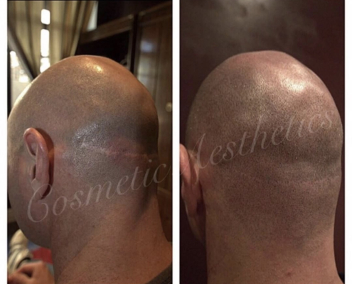 hair transplant FUT scar camouflage Scalp Micropigmentation