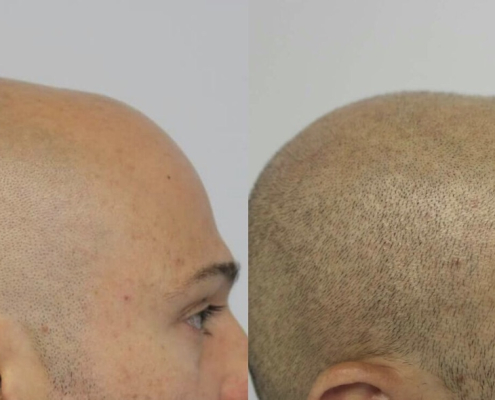 before and after scalp micropigmentation