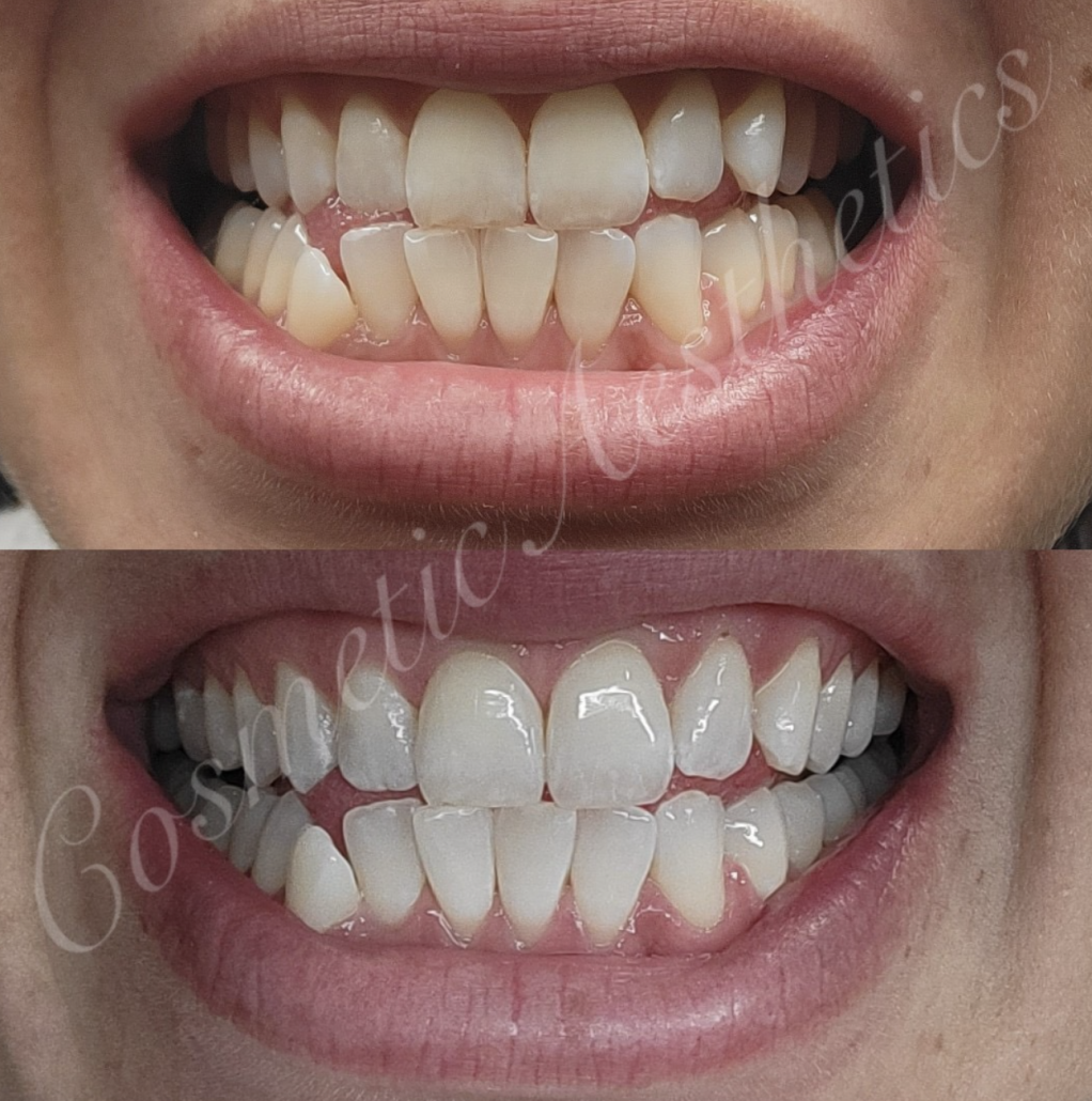 painless teeth whitening phoenix organic