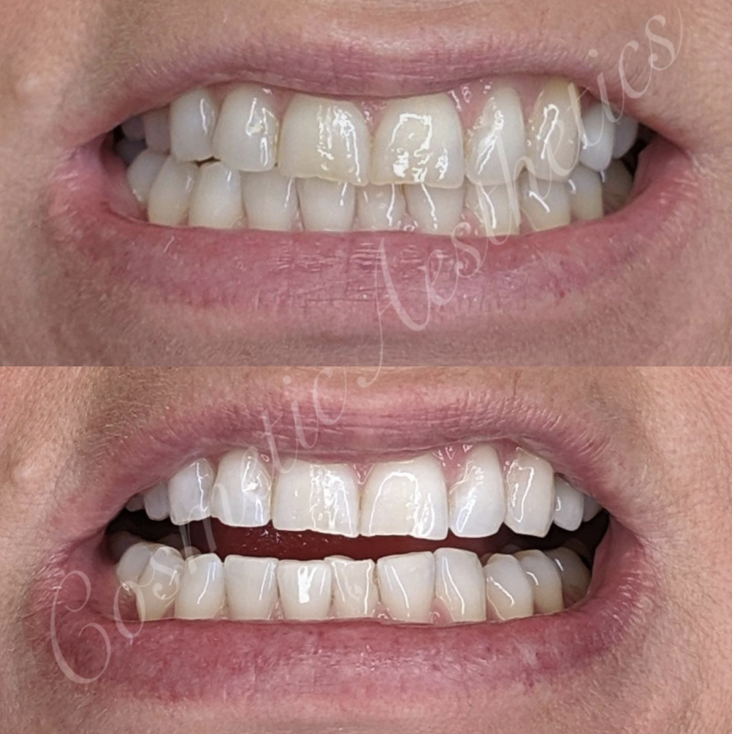 teeth whitening phoenix