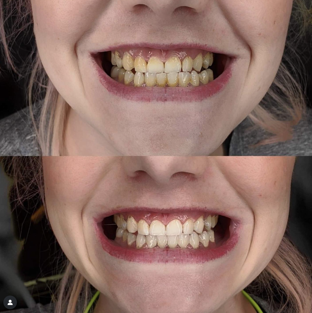 teeth whitening phoenix