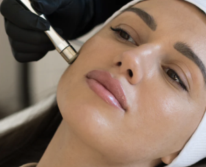 microdermabrasion phoenix