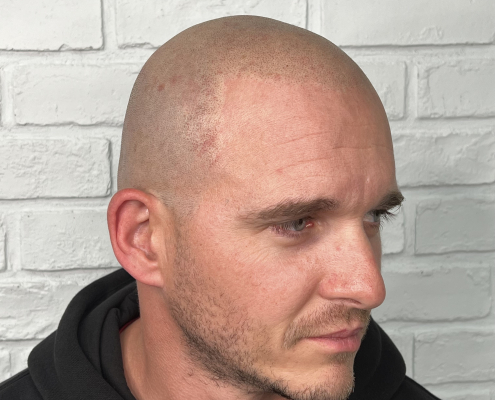 fresh scalp micropigmentation phoenix