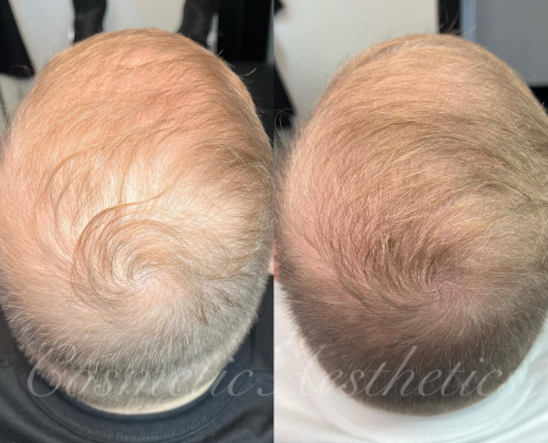 strawberry blonde red head scalp micropigmentation hair density tattoo phoenix