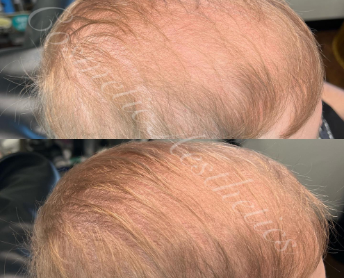 strawberry blonde red head scalp micropigmentation hair density tattoo phoenix