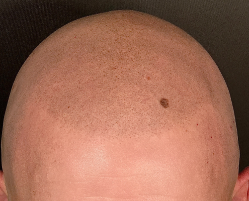 crisp scalp micropigmentation
