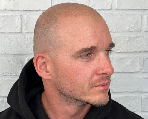 after scalp micropigmentation hair tattoo healed