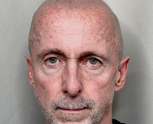 fresh Scalp micropigmentation hairline tattoo