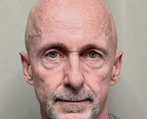 before scalp micropigmentation