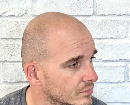 before scalp micropigmentation