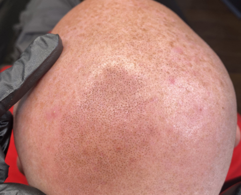 second session scalp micropigmentation in action