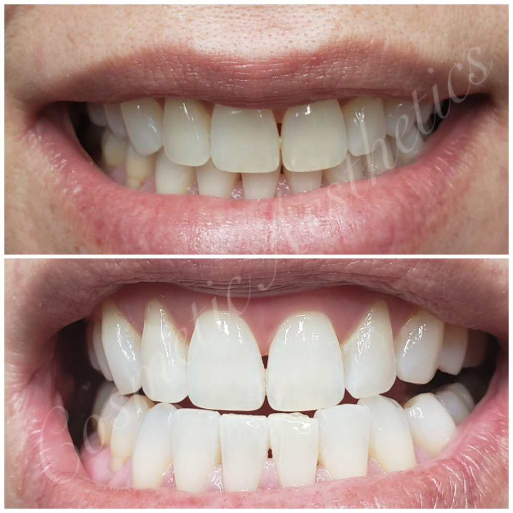 painless teeth whitening phoenix organic