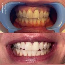 painless teeth whitening phoenix organic
