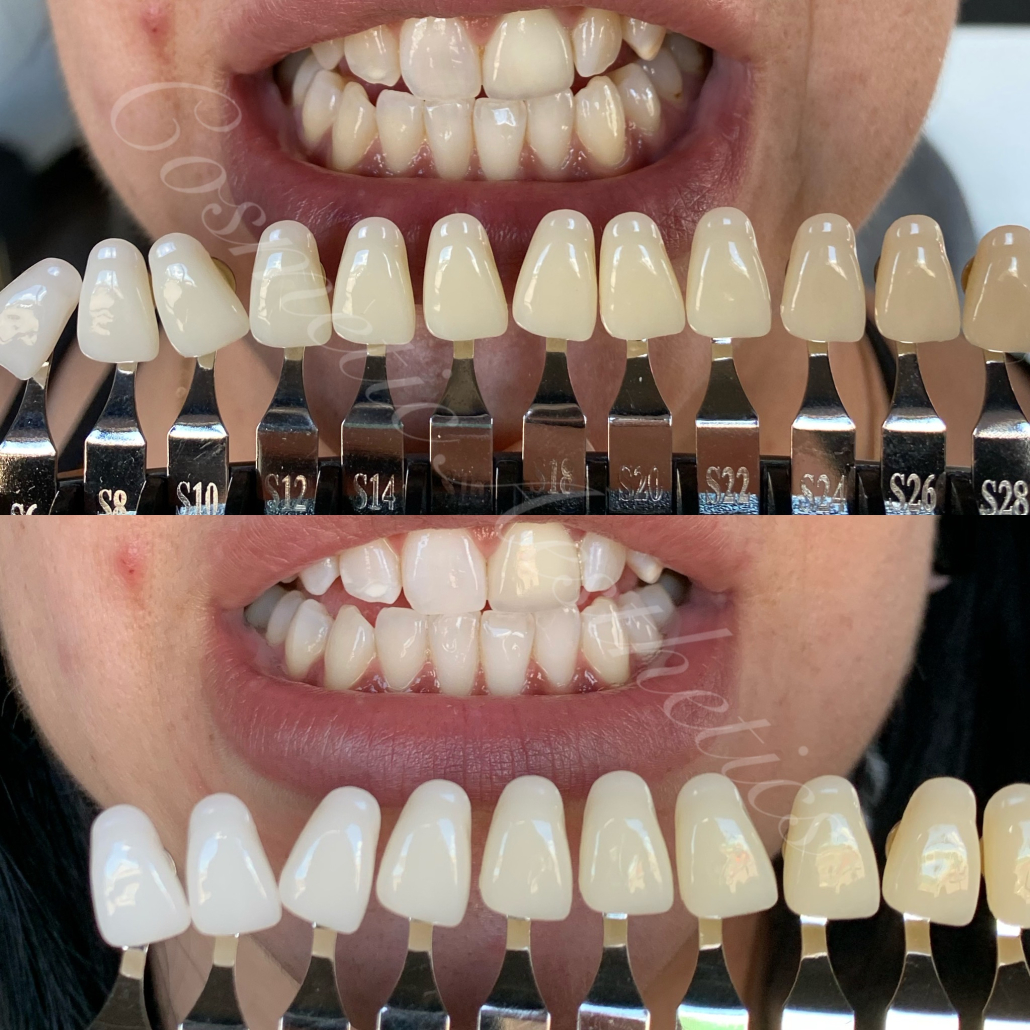 painless teeth whitening phoenix organic